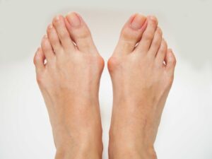 Bunion-300x225 Do Your Shoes Actually Give You Bunions?