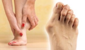 bunion-treatment-how-to-treat-the-lumps-on-your-feet-signs-of-something-more-serious-300x178 Do Your Shoes Actually Give You Bunions?