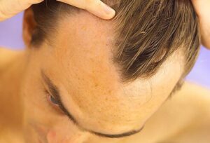 hair_scalp_s8_male_hair_loss-300x204 Symptoms of Alopecia, Causes and Treatment